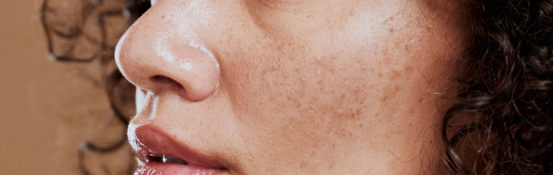 Paño, colasma o melasma - Siegfried Rhein