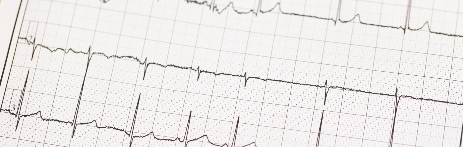 Electrocardiograma - Siegfried Rhein Sigfrid